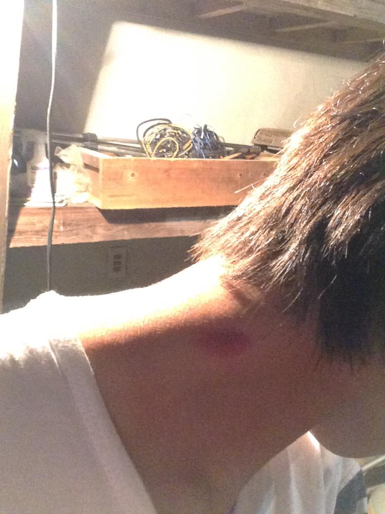 horiyu_'s tweet photo. ゆーだいが酔っぱらってキスマークつけてきた😂 http://t.co/cqHPEzKt3l