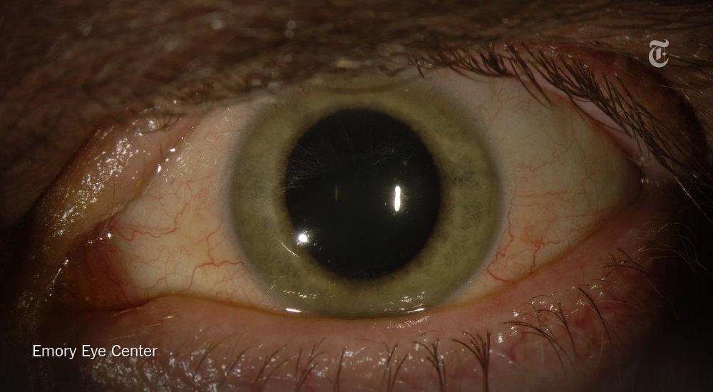 How can a viral infection change the color of a person’s eye? nyti.ms/1JVse7C