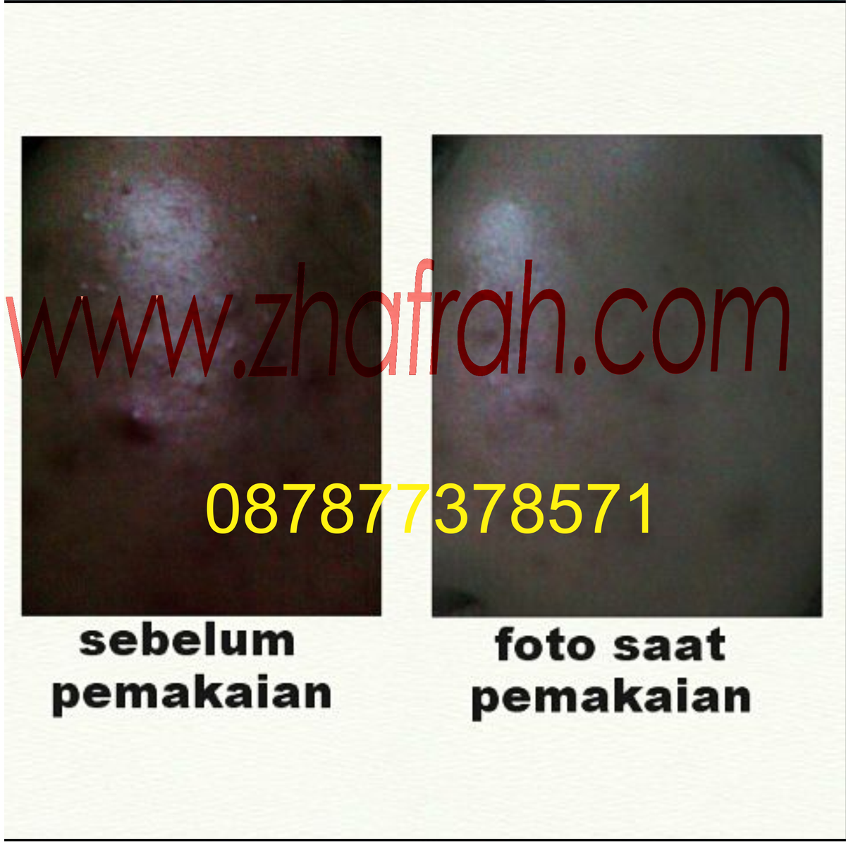 zhafrahcenter's tweet photo. Yakin gak mau sembuhin Jerawat kamu dengan zhafrah?? ;) https://t.co/M1K3iqNvoU
