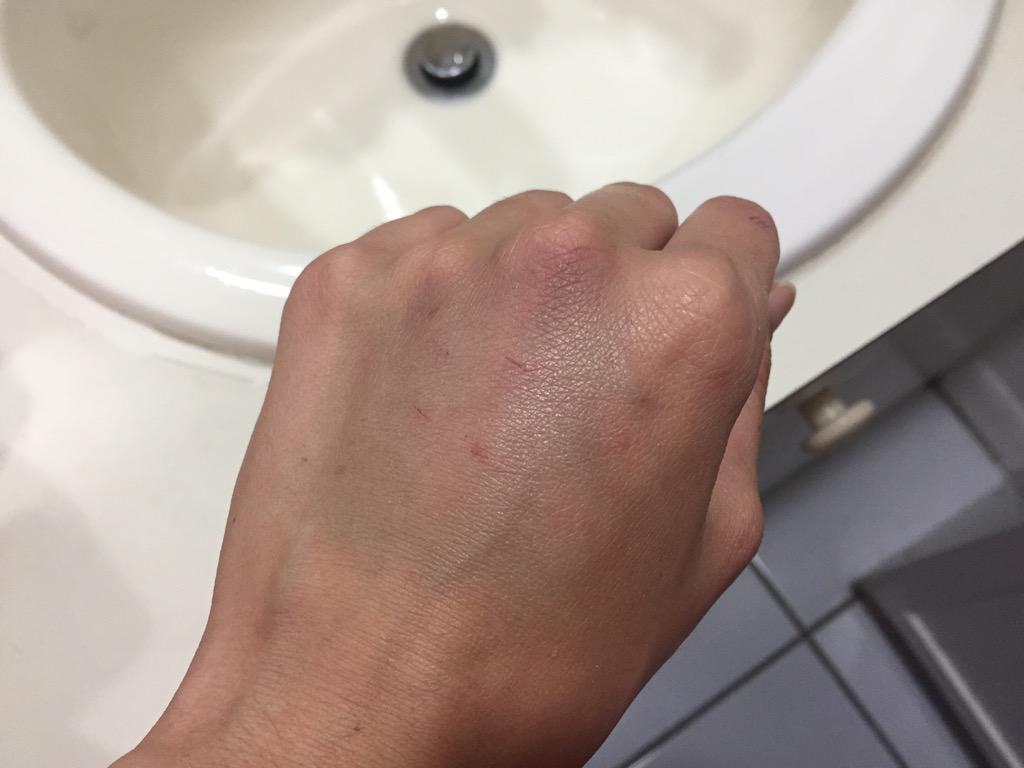 its_c_la's tweet image. Even when I try to be careful, I always end up with bruises from my runs 😕 #oneoffive #yucky