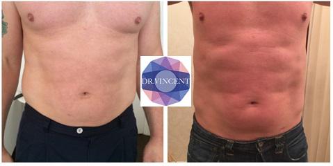 RT <a href="/ChangesClinic/">Changes Clinic</a>: Dissolve fat with <a href="/Aqualyx/">Aqualyx</a>. For men &amp; women, affordable, results in 4 weeks, perfect for holidays.