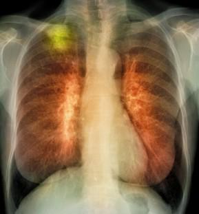 WIRED's tweet photo. Cuba has a lung cancer vaccine -- and America wants it http://t.co/WtUS5ACePu http://t.co/PBNs040KkT