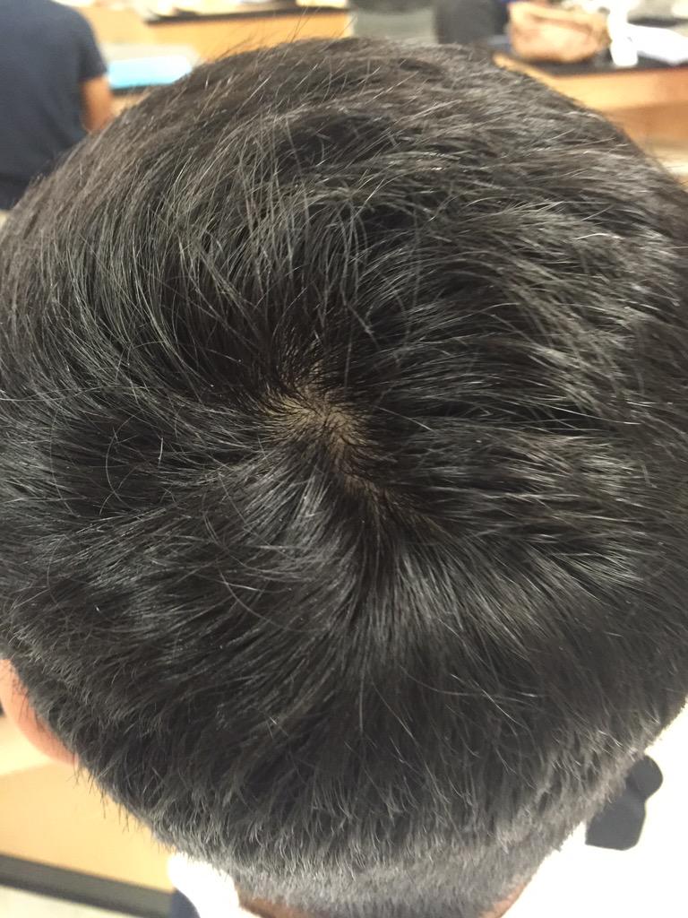 つむじない人はいない 普通のつむじとつむじはげの境界はどこ ハゲケン