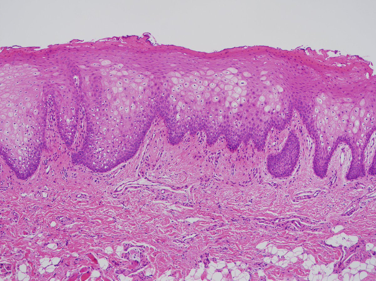 WHITE SPONGE NEVUS - EAOM