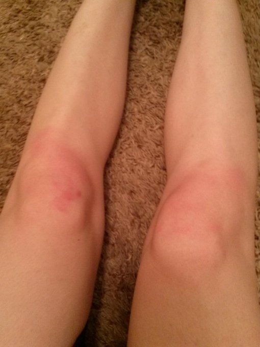 New stripper bruises. 5 months since stage! Gah. Tomorrow I'm dying. Lmao http://t.co/etWFnRYGP1