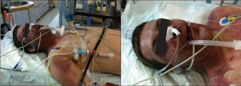 MayoClinicEM's tweet photo. A primer in blunt thoracic trauma
http://t.co/V7NrRmngL1
#FOAMed http://t.co/VrGMYAyp5j