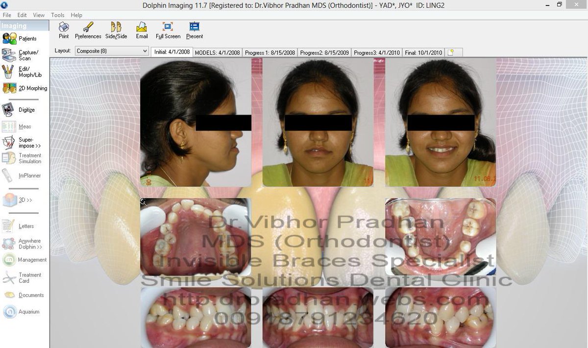 drpradhan's tweet photo. ONE OF MY INVISIBLE BRACES CASE at https://t.co/WsoqEoQVw3 http://t.co/JGpdH4AOey