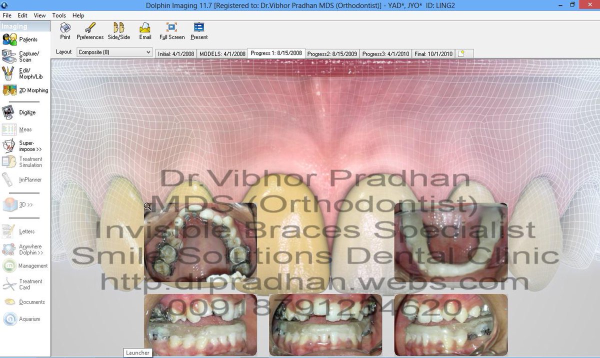 drpradhan's tweet photo. ONE OF MY INVISIBLE BRACES CASE at https://t.co/WsoqEoQVw3 http://t.co/JGpdH4AOey