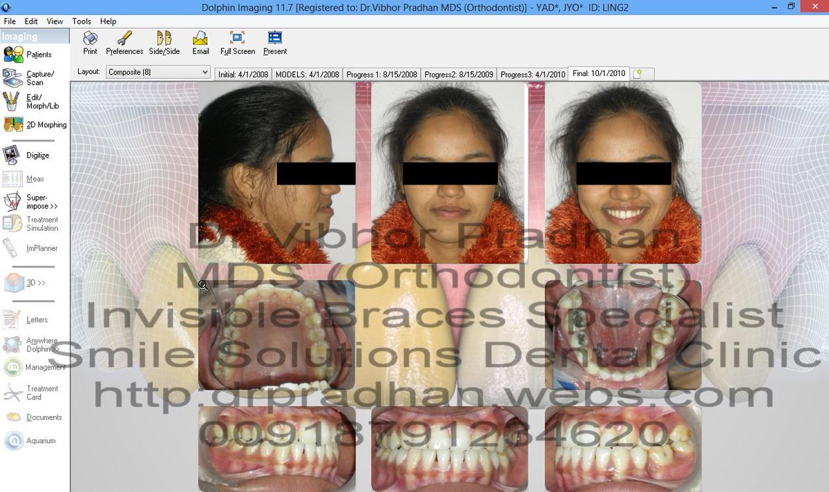 drpradhan's tweet photo. ONE OF MY INVISIBLE BRACES CASE at https://t.co/WsoqEoQVw3 http://t.co/JGpdH4AOey