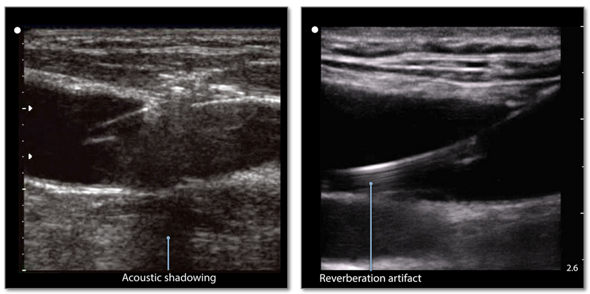 SonoSim's tweet photo. #USTip: Acoustic and reverberation artifact may serve as visual guides to help localize a needle within a vein. http://t.co/EvJuxqFPVo