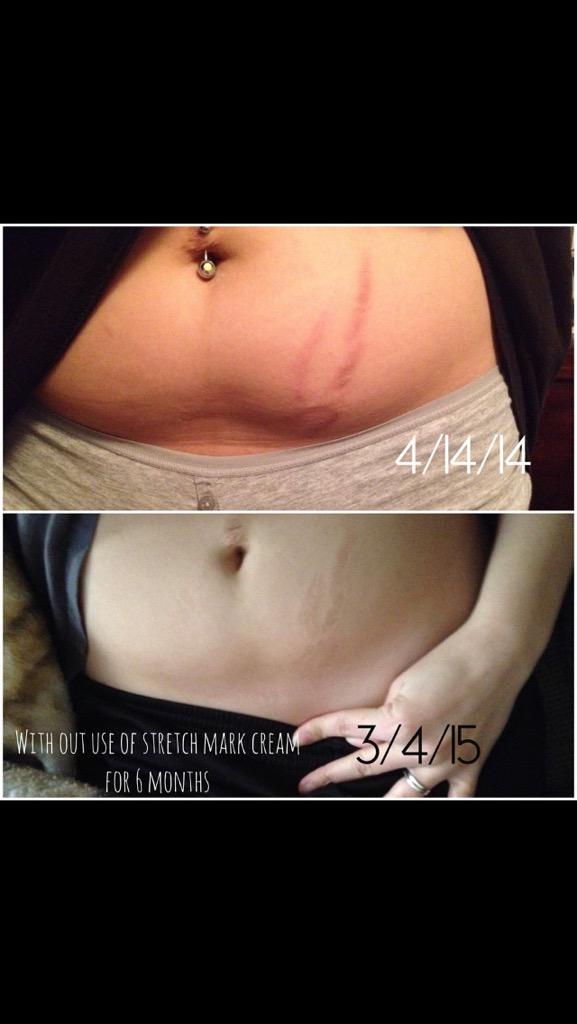 ash_luca1's tweet photo. Anyone out there need to get rid of stretch marks?? I'm looking for two ladies who would like to do so! http://t.co/b518xw0RG6