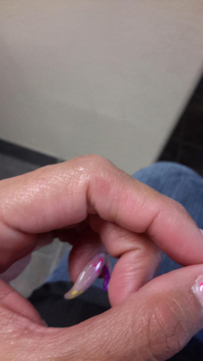 tish_burke's tweet image. I just gave myself a frog / blister.  #tabletproblems #tablet #phonerulesmylife