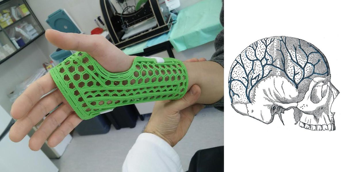 3DPrintBoard's tweet photo. WASP Teams With Rizzoli Institute to Make 3D Printed Conductive Casts &amp; Cranial Implants - http://t.co/d334vXXNQh http://t.co/IEAJIUYVWK
