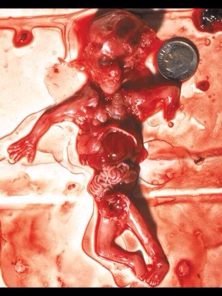 jandcalderon985's tweet photo. Cuando abortas, estás matando. Es duro, pero se hace esto (abortar) cada 5 minutos en España. http://t.co/eYoMPsmlxp