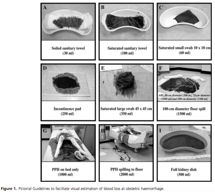canibagthat's tweet image. How bad are we at estimating blood loss? 

drive.google.com/file/d/0Byt9Tp…

#FRCPCAnes