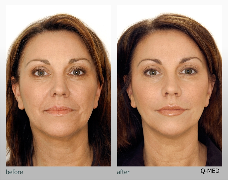 Evolv_aesthetic's tweet photo. Lip &amp; Nose to Mouth Model Treatments - £75 - Sunday 31st May - at Albert Dock Liverpool. Call Pennie on 07516729700. http://t.co/5ilql0Gqfb