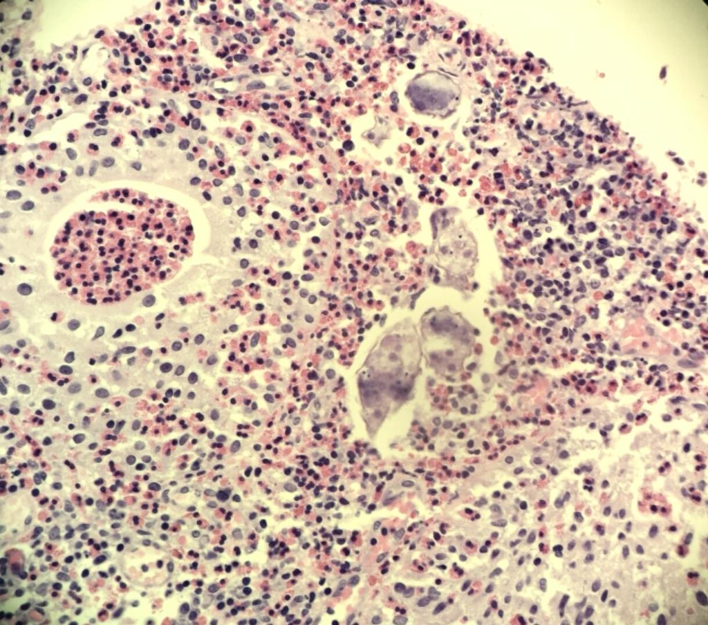 LinskeyKaty's tweet photo. Schistosomiasis in bladder: "I've been looking for it for 35 years" (my colleague who is near retirement) #pathology http://t.co/RZUWQjoYJO
