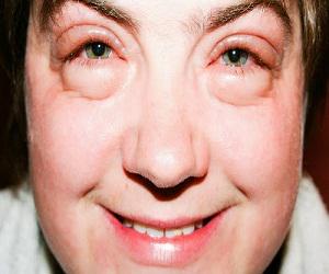 Отеки от недосыпа. Отеки от недосыпа. Отеки от недосыпа. Пастозностьзность лица. Круги под глазами.