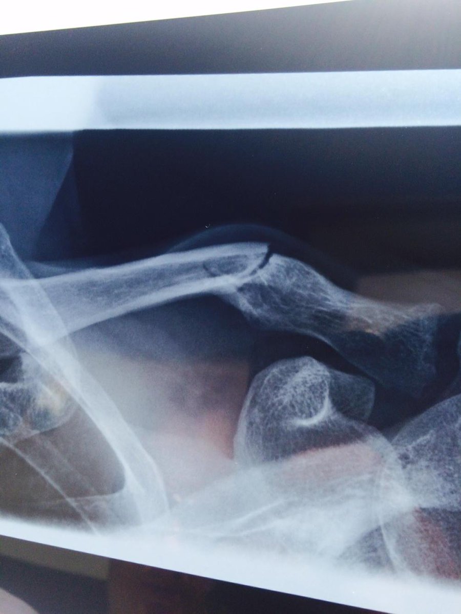 AndrewBensley's tweet image. Victorian jockey, Mark Pegus has broken collarbone in track work fall this morning. Off to see doctor tomorrow.