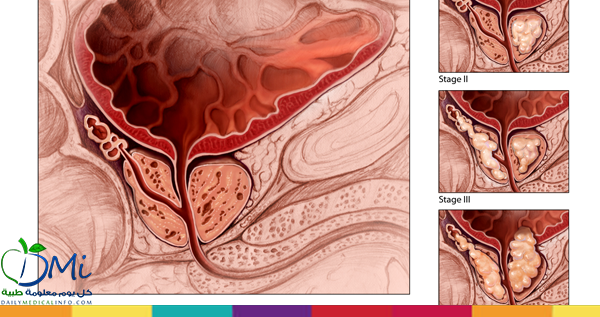 DMedicalinfo's tweet photo. معلومات مهمة عن سرطان البروستاتا .. ما هي أنواعه؟ كيف يتم تشخيص هذا  السرطان؟ .اكتشف :
http://t.co/MqfTIdTkuT
#طب http://t.co/dGgJ2Jn2BH