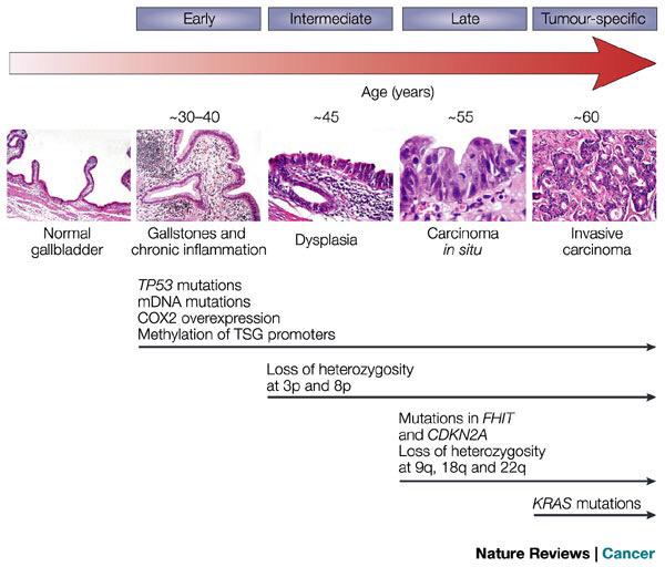 studyhistology's tweet photo. Pathogenesis of gallbladder carcinoma.  http://t.co/fMuEhOPynk http://t.co/Hd9daSArnC