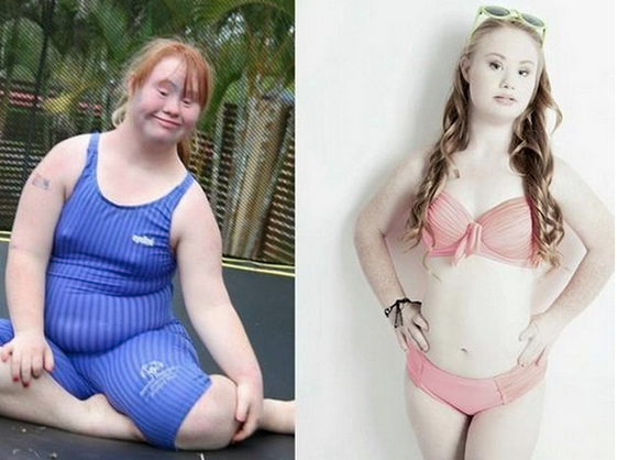 BuzzFeed's tweet photo. Meet the aspiring teen model who is redefining standards of beauty http://t.co/BUfzrZ3MDI http://t.co/nKG0r3gHUk