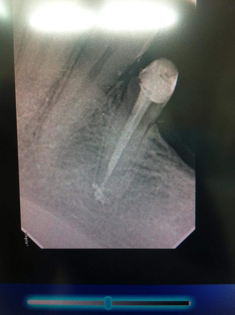 AnaBelenCaRi's tweet image. Y para terminar....una de REEndo!!! @AEDE1 #protaperNext #Endoactivador #EdtaLiquido #Calamus #FibraDeVidrio #dique