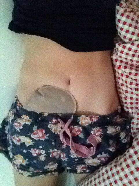 sophiewright94's tweet photo. Today is #worldIBDday 💜 so please show your support to the thousands of brave people living with #crohns &amp; #colitis 💜 http://t.co/F2nyO8k7cb