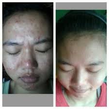537dff62bbd844b's tweet photo. Masker spirulina untuk menghilangkan jerawat.. 
info 749ACE27 or 082127525604 http://t.co/lPbheKSO0F
