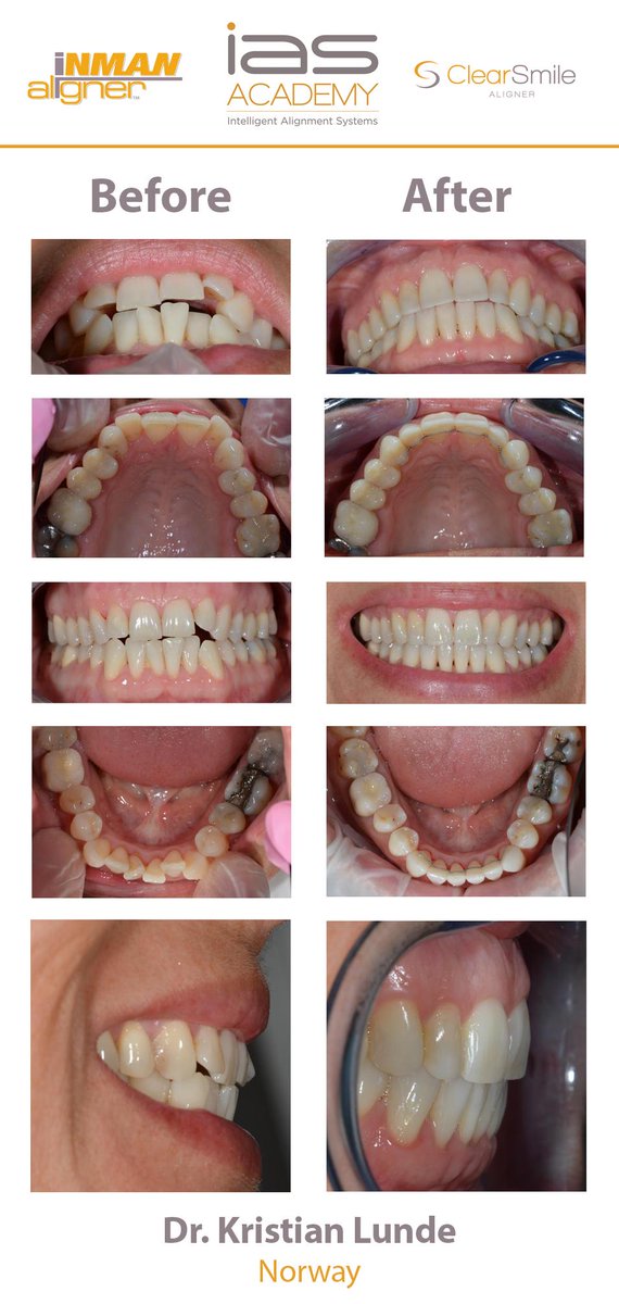 IASClearSmile's tweet photo. #IASCOTM Dr. Kristian Lunde's 13 Week @TheInmanAligner &amp; 6 Week ClearSmile Aligner Case. What a transformation! http://t.co/k3WeMnUije