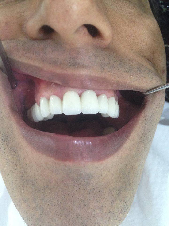 Çürük ve eksikler nedeniyle estetik görünüşü bozuk olan hastanın ZİRKON VEPORSELEN yöntemiyletedavisi #gülüşüzesağlık