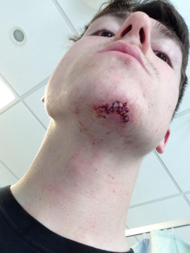 BadmanKLD's tweet photo. @RPHSDance Its all good👌 8 Stitches http://t.co/GZPbOYdFuc