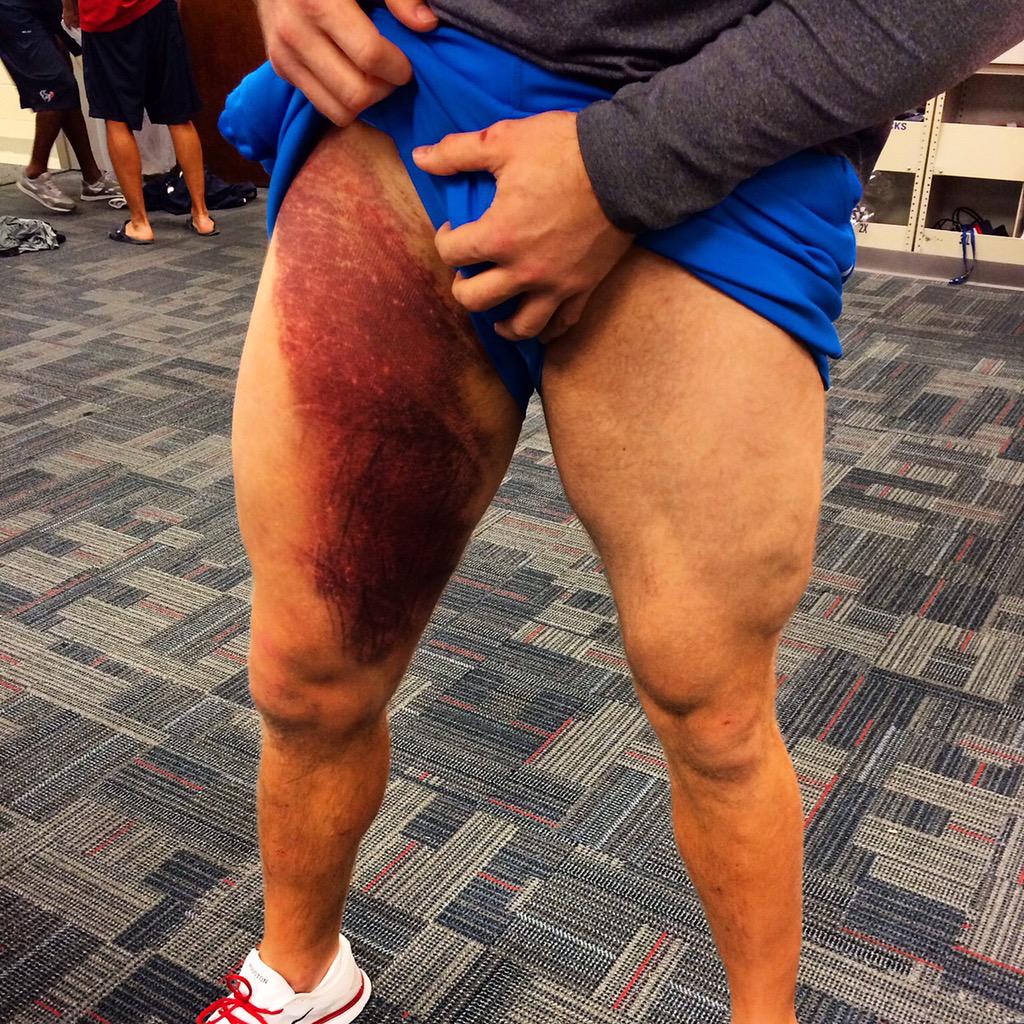 J.J. Watt Shares Photo of Massive Leg Bruise