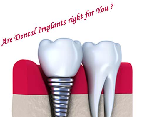 Dentistry5306's tweet photo. #DentalImplantsMississauga

http://t.co/DaWYblQPDN http://t.co/BqPsLHl2Vp