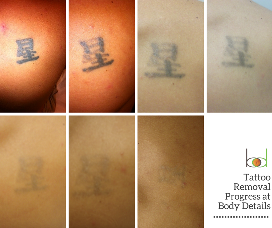 BodyDetails's tweet photo. Check out another client's progress! We don't like to brag...actually, yes we do! ;) #TrueLaser http://t.co/kCHVTJj3lO