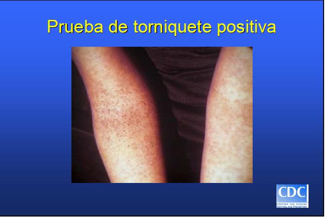 Is PETECHIAE a side effect of IMODIUM? (FactMed.com)