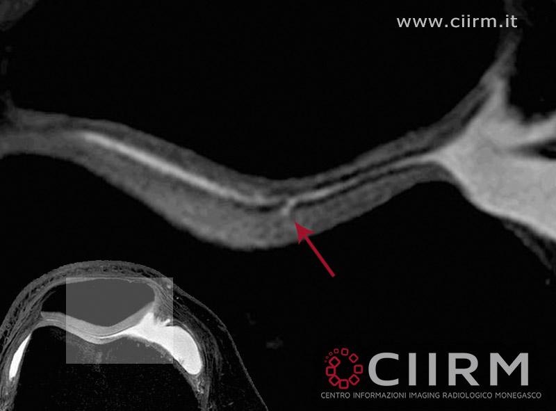 CIIRM's tweet photo. Speciale seq RM dedicata alle cartilagini che mostra una micro ulcerazione  troclea femorale  http://t.co/t1l0raz7zS http://t.co/K6Xr0P80Y4