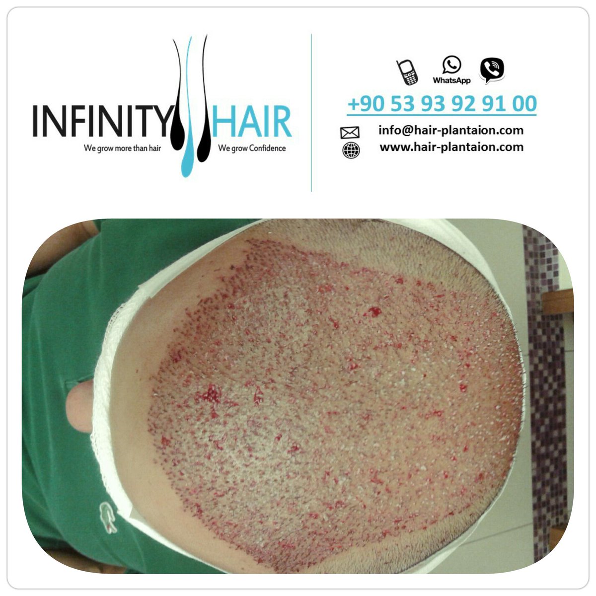 infinityturkey's tweet photo. #infinityhair
#hairtransplant
#turkey
#انفينيتي_هير #زراعة_الشعر #تركيا #السعودية #الكويت #قطر #البحرين #الامارات http://t.co/LFO1QLh1H1