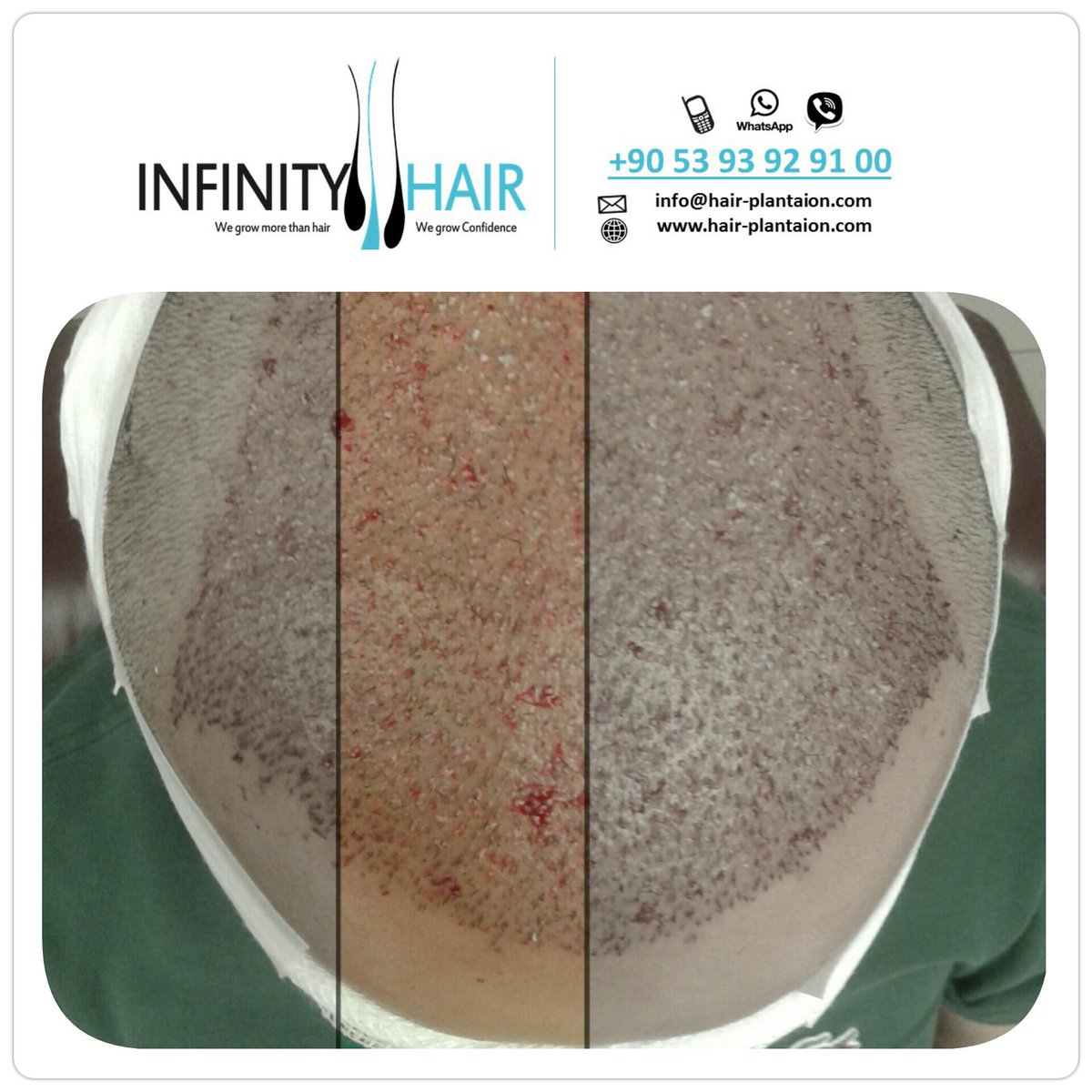 infinityturkey's tweet photo. #infinityhair
#hairtransplant
#turkey
#انفينيتي_هير #زراعة_الشعر #تركيا #السعودية #الكويت #قطر #البحرين #الامارات http://t.co/FfegQwuaSR