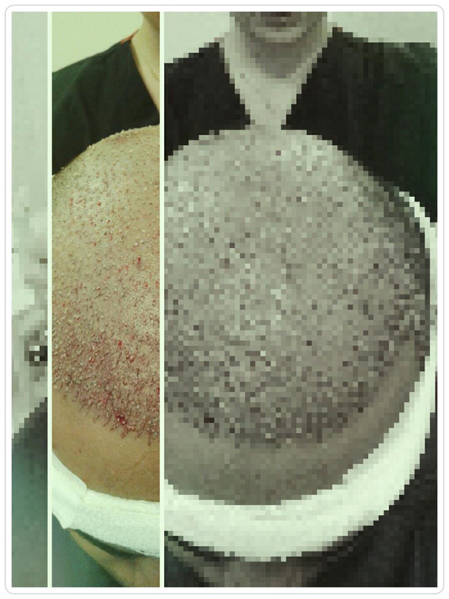 infinityturkey's tweet photo. #infinityhair #hairtransplant #turkey #انفينيتي_هير #زراعة_الشعر #تركيا #السعودية #الكويت #قطر #البحرين #الامارات http://t.co/pNmor3T7KM