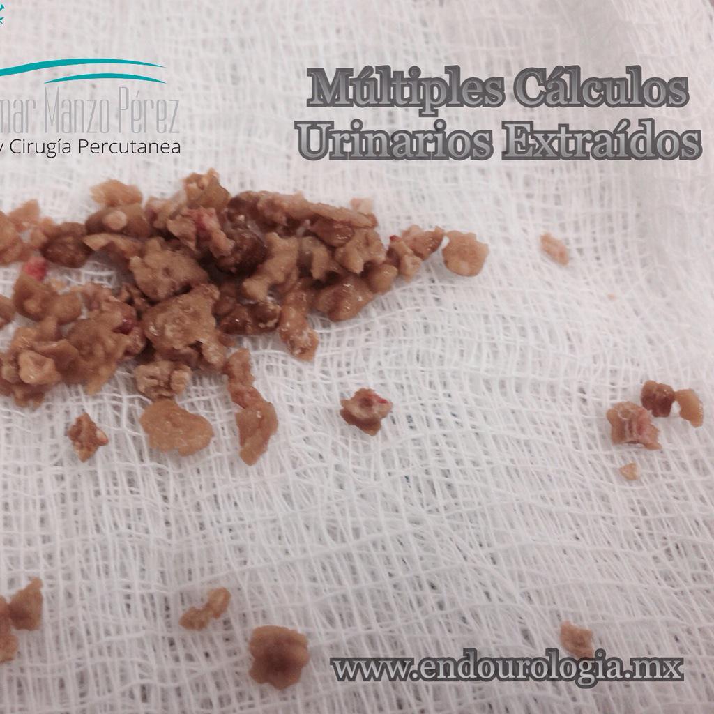 Urinary  Stones: the urinary tract destroyers. #Endourology #endourologia #Brauliomanzo #litiasis #urinarycalculi