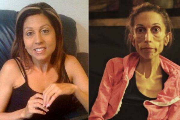 revistavistazo's tweet photo. Una mujer con un grave caso de #anorexia pide ayuda en internet para salvar su vida. http://t.co/BrsU4YIJjX http://t.co/S1hVgFuZjI