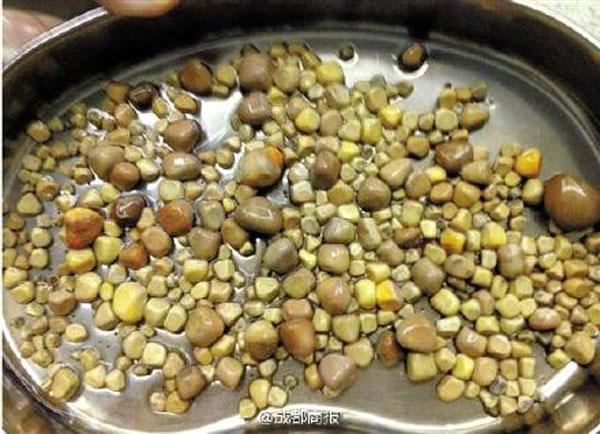 Gossip Lanka, Hiru Gossip, Lanka C News - Doctors remove 420 kidney stones from patient's body in China Gossip Lanka, Hiru Gossip, Lanka C News - Doctors remove 420 kidney stones from patient's body in China