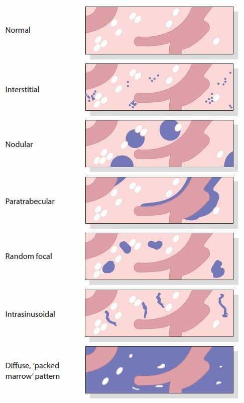 Bone marrow infiltration