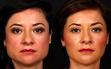 realself's tweet photo. #Botox isn't just for wrinkles. Learn more about the latest #trend for jaw contouring: http://t.co/rS6SSEsf8V http://t.co/JckvgffqWw
