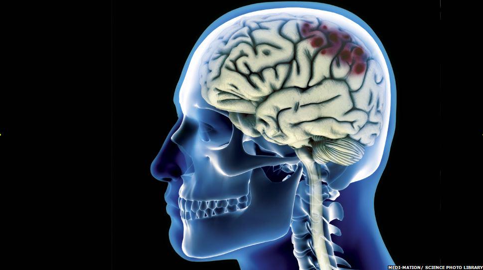 BBCAccessAll's tweet photo. The new blog documenting the aspirations and abilities of people with brain injuries http://t.co/oW5UuHQH9T http://t.co/LdlJtFS730