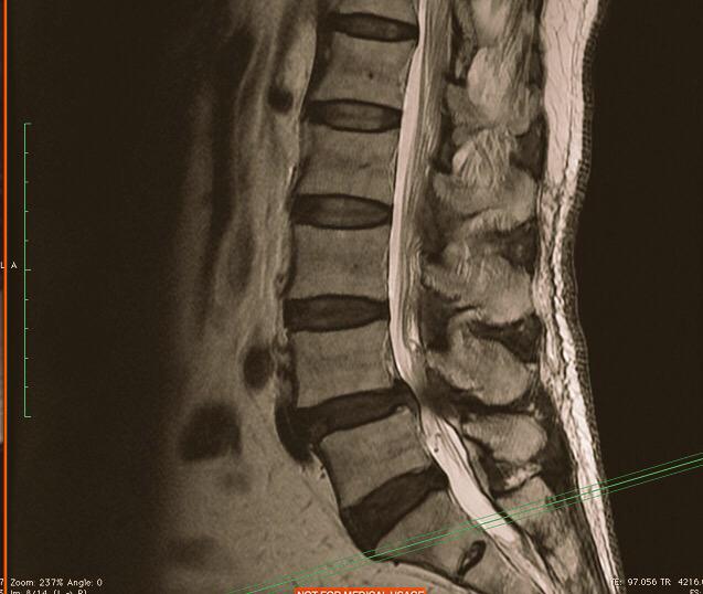 ilif247's tweet photo. However if this patient was in their 40s or 50s. Probably would do Xlif and posterior decompression and fusion. http://t.co/tHLQj4eybM