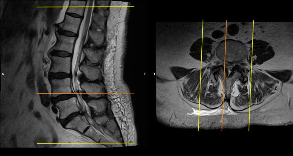 ilif247's tweet photo. Case today.   Active 79 yof with right leg pain and back pain.   Planning L5-S1 dissectomy and Ilif l4-l5. http://t.co/Le6PzVaXzm