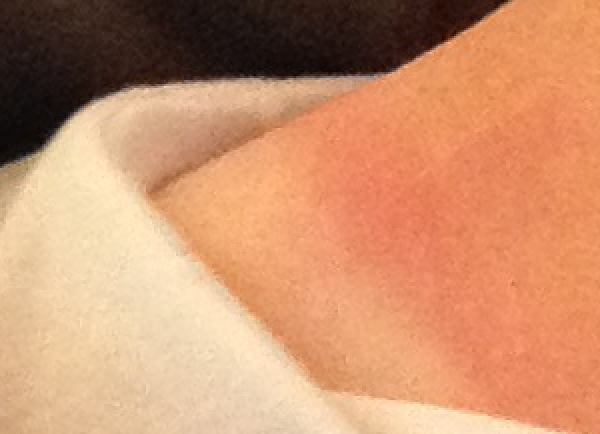 BeachPassSPF30's tweet photo. #SunburnJournal 5/27 The #UVIndex was above 8. #sunburn developed while walking around after #lunch. http://t.co/nXlBReUiU6