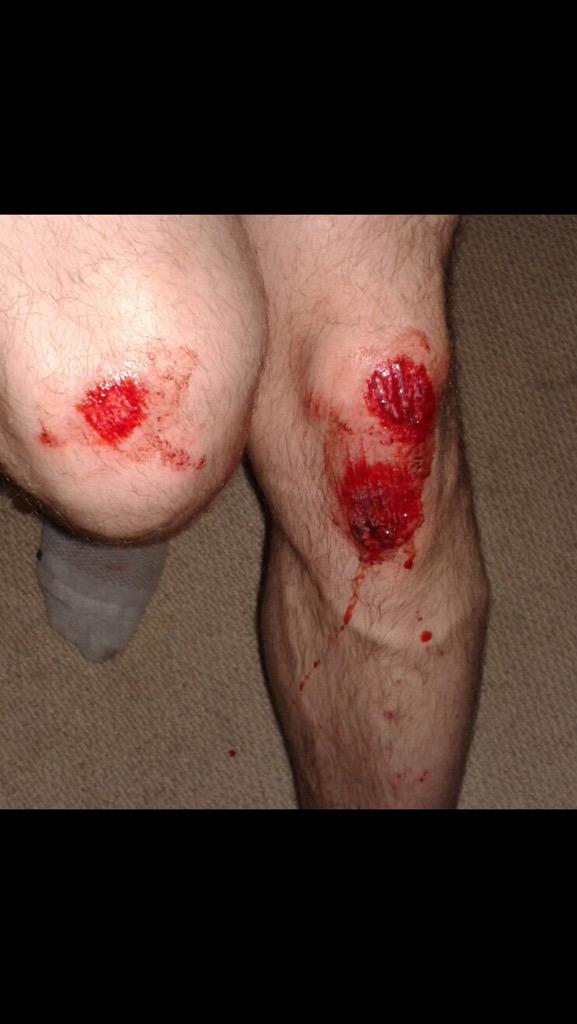 seashell03's tweet photo. This is my sons knees after coming off his bike at hay market tram lines! http://t.co/s50ferXSay